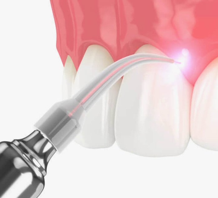Consultoría periodontal no quirúrgica